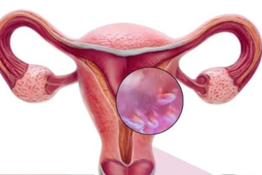 HPV شایع‌ترین عفونت مقاربتی جهان؛ هشدار متخصصان درباره پیامدهای خاموش این ویروس